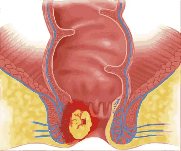 Illustration of an anal cancer tumor in the anal canal