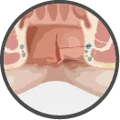 Diagram of an anal fissure, a tear in the lining of the anal canal
