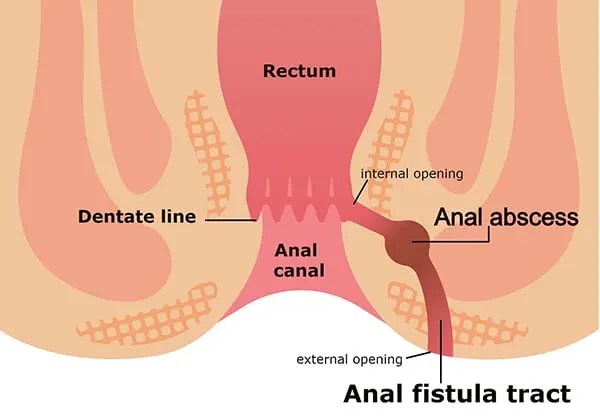 Diagram of the rectum and anal canal showing an anal abscess and the fistula tract