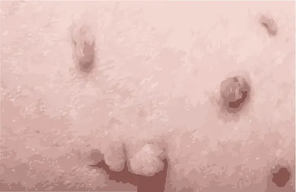 Close-up of anal and genital warts (condyloma acuminatum)