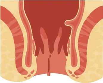 Illustration of anal skin tags