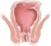 Illustration of anal stenosis, a narrowed anal canal