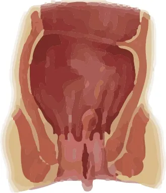 Illustration of an enlarged (hypertrophied) anal papilla at the dentate line