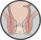 Cross-section diagram of internal and external hemorrhoids