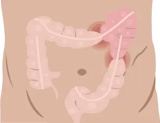 Illustration of the colon for irritable bowel syndrome