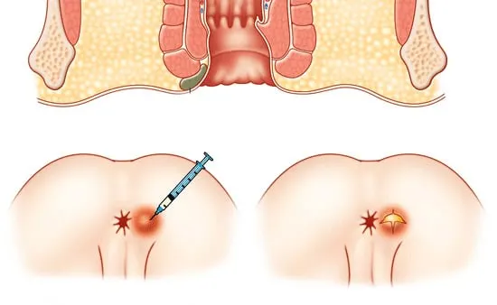 Illustration of a perianal abscess