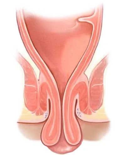 Illustration of rectal prolapse