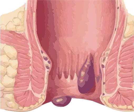 Illustration of an anal thrombus (thrombosed external hemorrhoid)